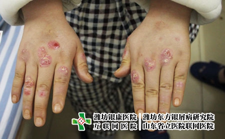 [銀屑病治療都詢濟南]怎么做才能夠有效預防牛皮癬