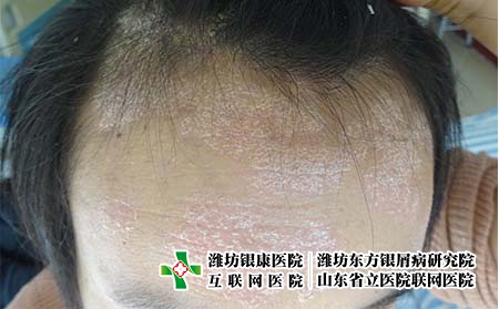 [銀屑病治療都詢濟南]怎么做才能夠有效預防牛皮癬