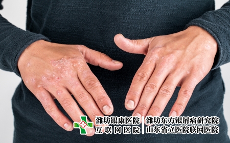攝圖網_506227449_患有粗俗的牛皮癬濕疹和其他皮膚?。ㄆ髽I商用）_副本