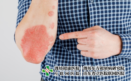 攝圖網(wǎng)_506432486_患有粗俗的牛皮癬濕疹和其他皮膚病（企業(yè)商用）