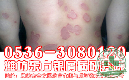 醫(yī)生講解   牛皮癬患者洗浴三禁忌