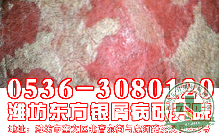 牛皮癬會(huì)不會(huì)致命呢？