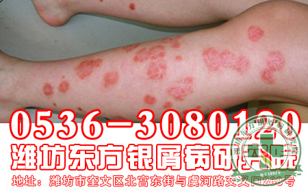 手術(shù)理想治療牛皮癬嗎