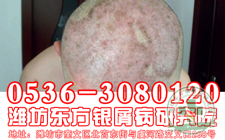 牛皮癬患者不要燙發染發為理想