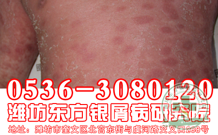 牛皮癬避免創傷和感染的重要性
