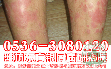 傳染會不會是導致銀屑病發病的誘因？