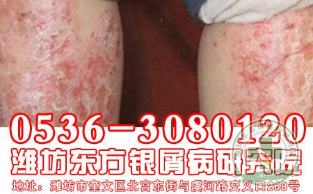 牛皮癬患者需要注意常識(shí)問題