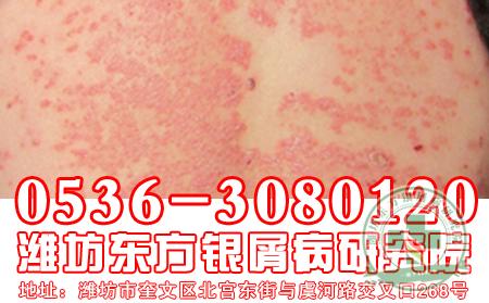 牛皮癬護(hù)理