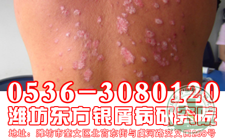 牛皮癬的常見病因