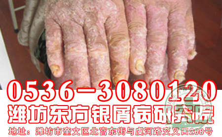 老年人要如何治療牛皮癬？