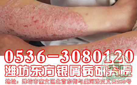 引起牛皮癬發(fā)作的原因有哪些？