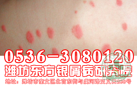 點(diǎn)滴型牛皮癬治療期間消退是什么癥狀