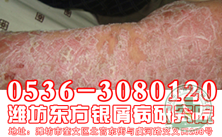 膿皰型牛皮癬怎么治療？