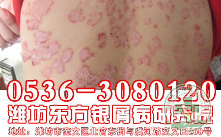 濟南牛皮癬醫院醫生解析牛皮癬治療有什么要求