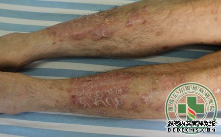 詳細為銀屑病患者介紹不同的銀屑病癥狀表現