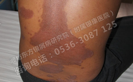 怎么治療牛皮癬才算正規(guī)