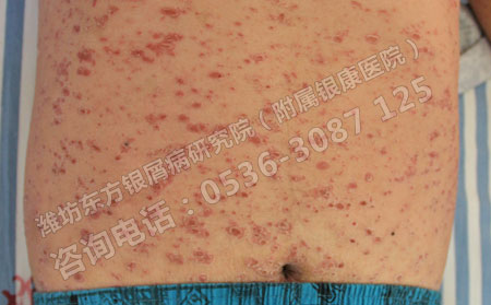 全身得了牛皮癬怎么治療優(yōu)勢大
