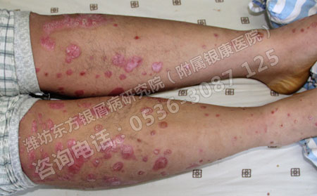 牛皮癬不治療會(huì)有什么后果?