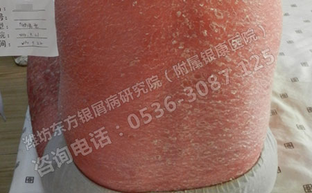 銀屑病患者劇烈運(yùn)動(dòng)后不要做這些事情