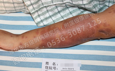 濟南銀屑病醫院治療尋常型牛皮癬怎樣