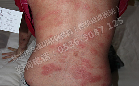 銀屑病發生的原因是什么