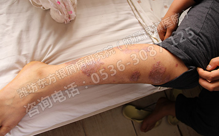 兒童銀屑病如何護(hù)理