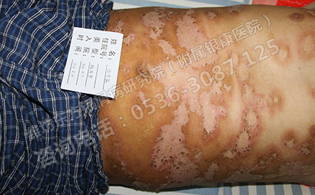 銀屑病的預(yù)防主要做到哪些方面