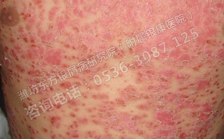導(dǎo)致銀屑病發(fā)生的關(guān)鍵因素有哪幾個(gè)