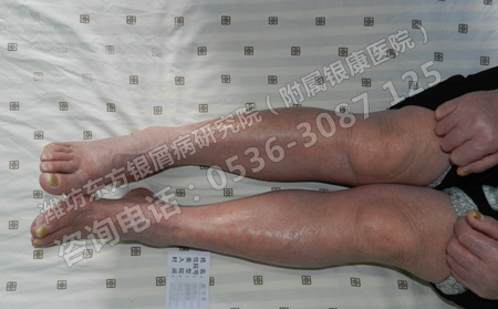 得了銀屑病怎樣護理才能避免復發(fā)呢