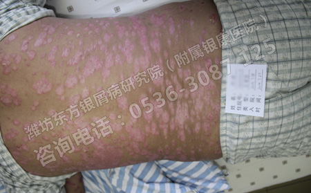 季節(jié)交替銀屑病患者要注意哪些飲食問題