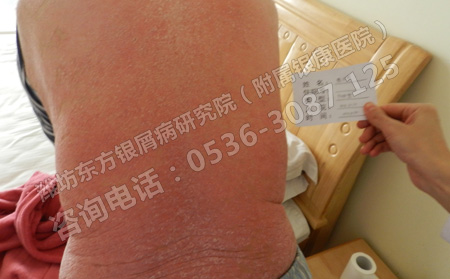 小孩營養不良引起銀屑病會有哪些危害