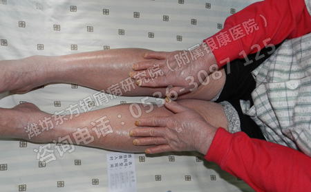 如何防止銀屑病在急性進(jìn)行期泛發(fā)全身呢