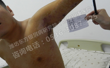 濟(jì)南預(yù)防銀屑病有沒(méi)有比較理想的方法呢