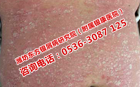 尋常型牛皮癬理想自己恢復嗎