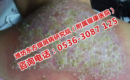 治療銀屑病治療方法理想的方法