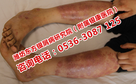 濟南治牛皮癬哪家醫院理想