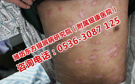濟(jì)南牛皮癬醫(yī)院治牛皮癬多少錢