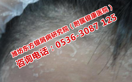牛皮癬有掉頭發(fā)的癥狀嗎