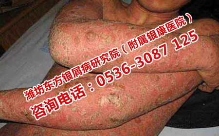 如何對(duì)牛皮癬治療減少?gòu)?fù)發(fā)