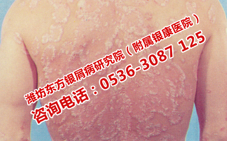 護(hù)理牛皮癬的三大方面