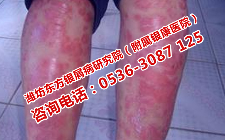 專門治療牛皮癬的醫(yī)院