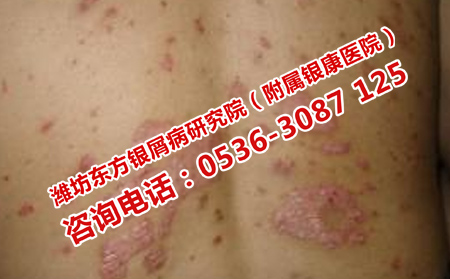 濟南哪家醫(yī)院治銀屑病理想