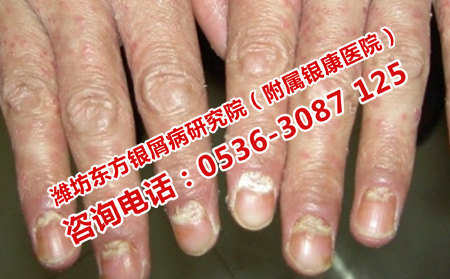 鋼城治銀屑病醫(yī)院