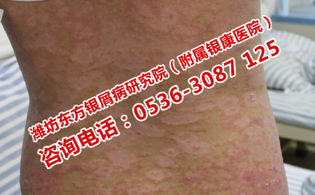 關(guān)節(jié)型銀屑病的冬季護(hù)理方法